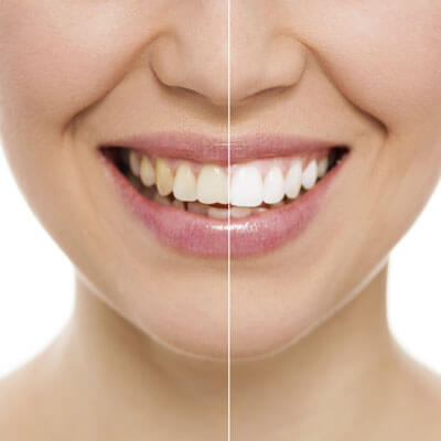 Teeth Whitening in Howick